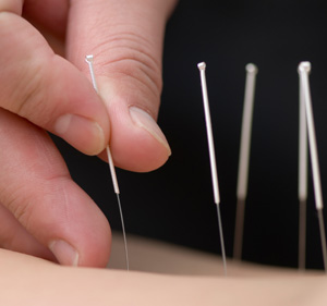 acupuncture benefits